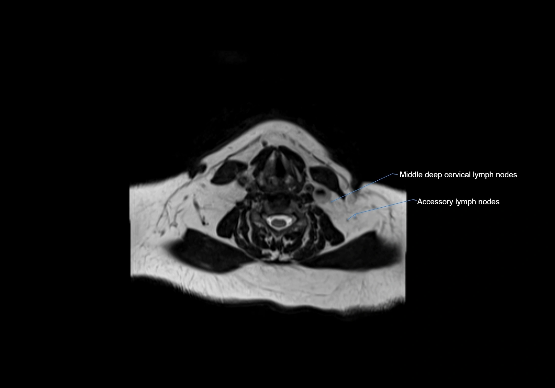 Neck axial  lymph node cross sectional MRI anatomy 3T MRI  image-img-00001-00065.webp